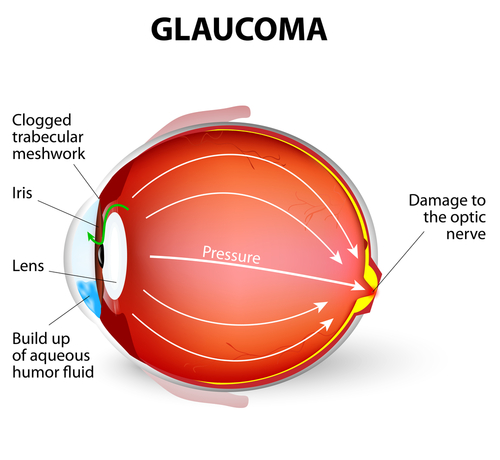 Glaucoma Rhode Island