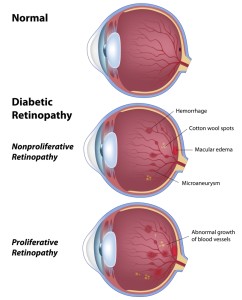 Diabetic Eye Disease Rhode Island